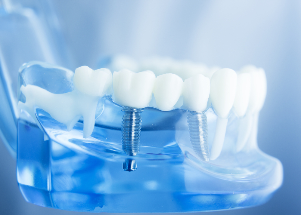 歯科用インプラント技術の進歩